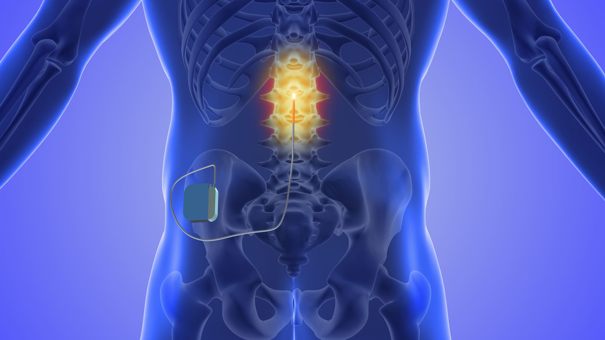 spinal stimulation
