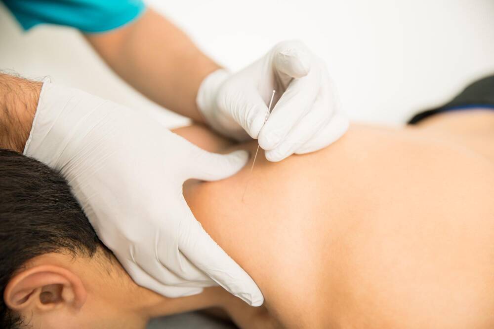 Dry needling therapy being performed on the neck to relieve muscle tension and chronic pain